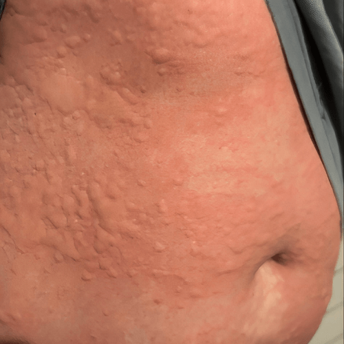 tick bite Local allergic reactions tick bite Local allergic reactions