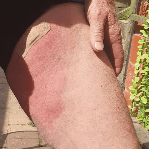 tick bite Local allergic reactions tick bite Local allergic reactions