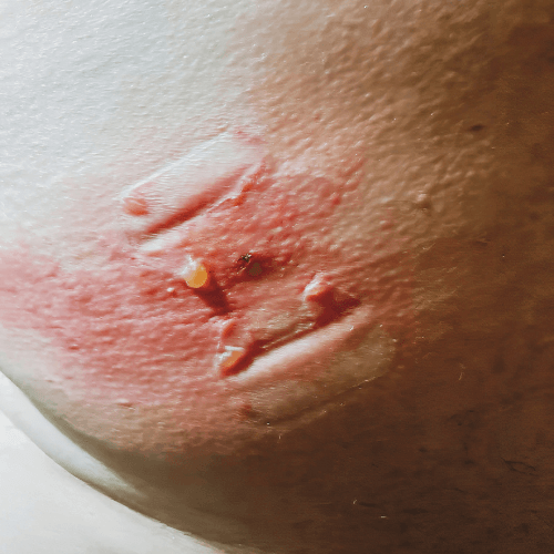 tick bite Local allergic reactions tick bite Local allergic reactions