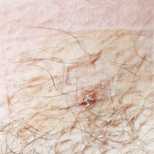 Alpha gall reactions