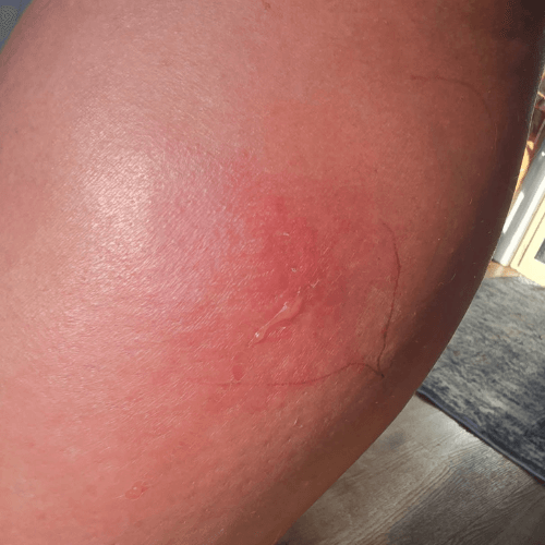 Localised allergic reaction that developed into systemic infection tick bite Local allergic reactions